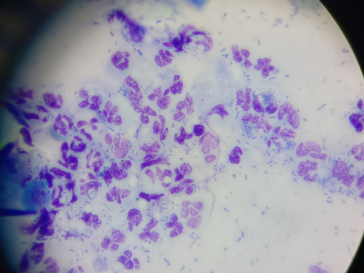 Otitis externa unter dem Mikroskop_Entzündungszellen und massenhaft stäbchenförmige Bakterien Otitis externa unter dem Mikroskop_Entzündungszellen und massenhaft stäbchenförmige Bakterien